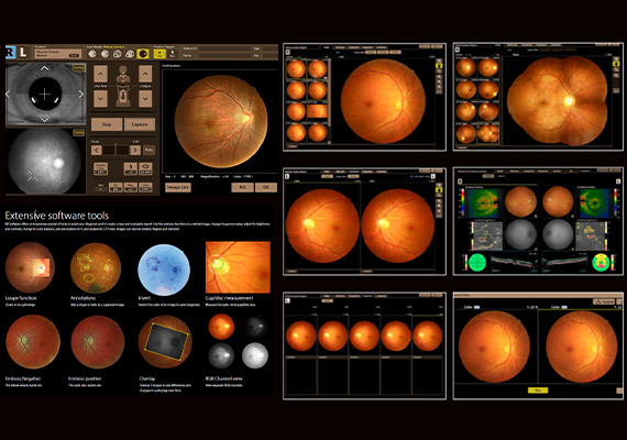 Retinal Expert Software